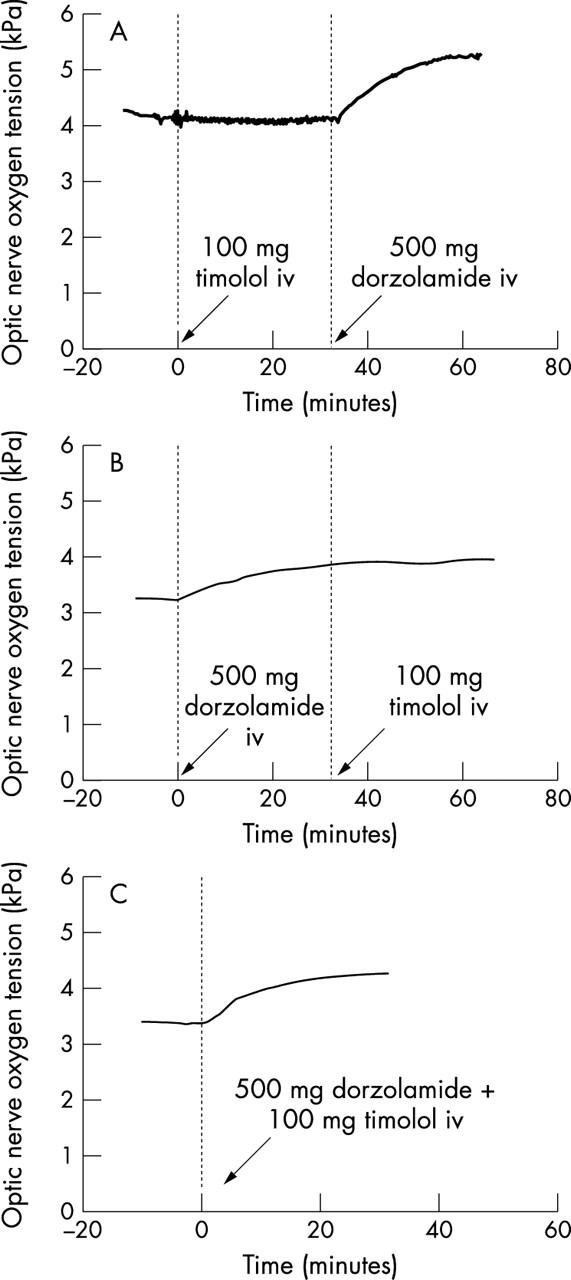 Dorzolamide HCl