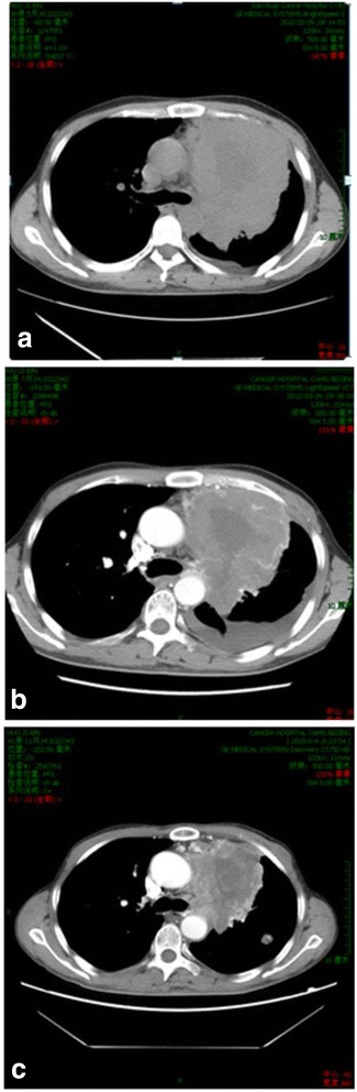 Anlotinib